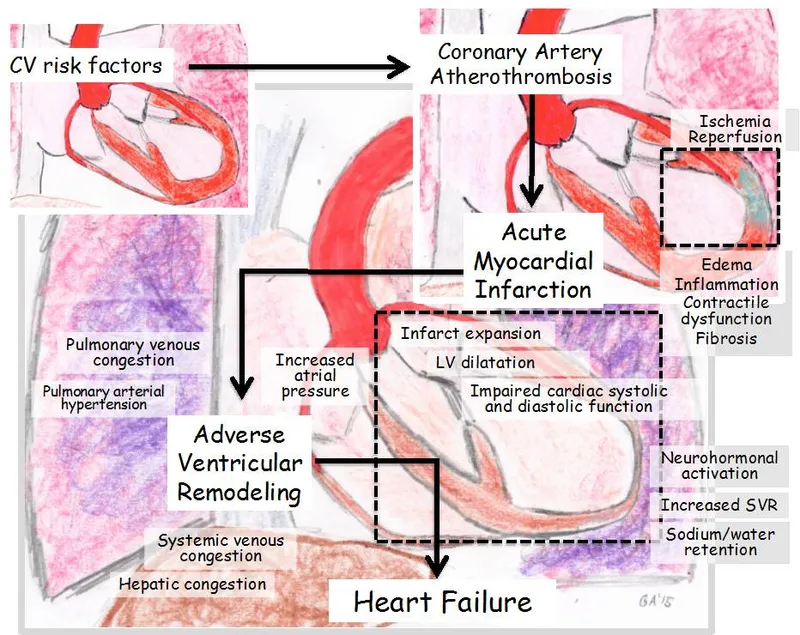 Diagram showing cardiac remodeling process from acute MI to chronic heart failure