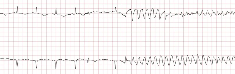 ECG strips showing progression from normal rhythm to ventricular fibrillation in acute MI