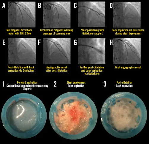 Angiographic images showing before and after primary PCI with stent placement