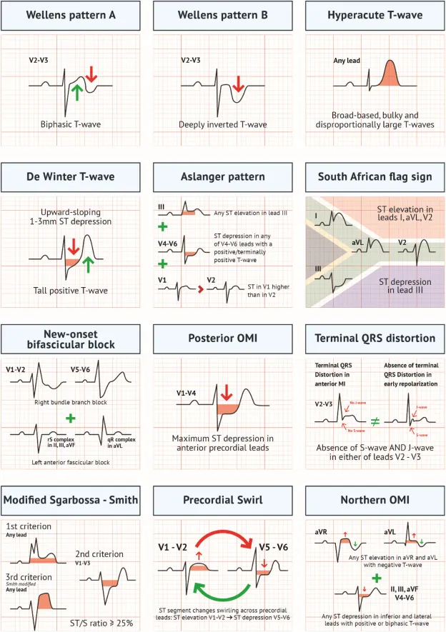 ECG examples showing STEMI equivalents including de Winter pattern and Wellens syndrome