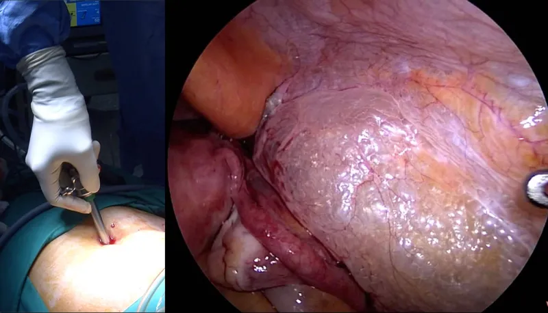 Laparoscopic surgery setup showing trocar placement and CO2 insufflation system