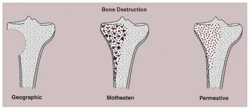 Radiographic patterns in bone tumors with diagnostic correlation