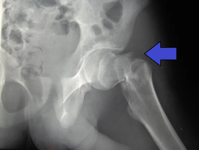Figure 1: AP pelvis X-ray showing displaced intracapsular neck of femur fracture with disrupted Shenton's line