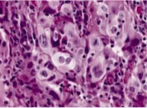 nuclear pleomorphism