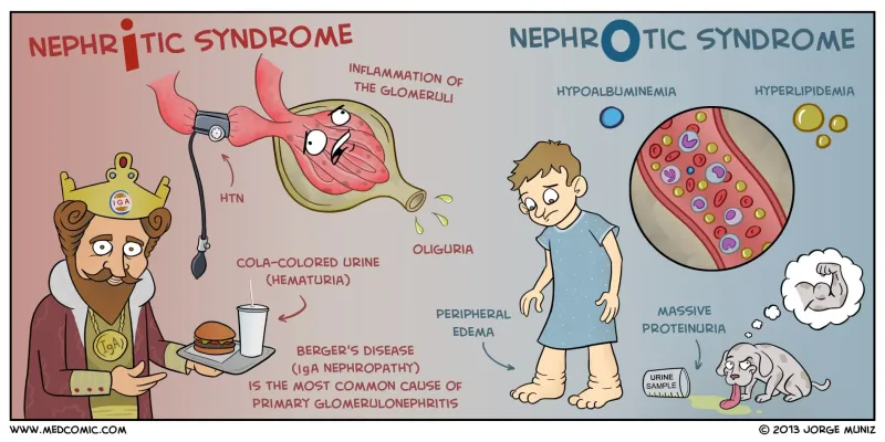 Comparison diagram showing nephritic vs nephrotic glomerular changes
