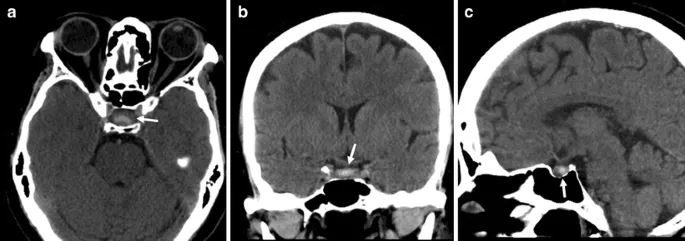 CT scan showing pituitary apoplexy with hemorrhage into enlarged sella turcica