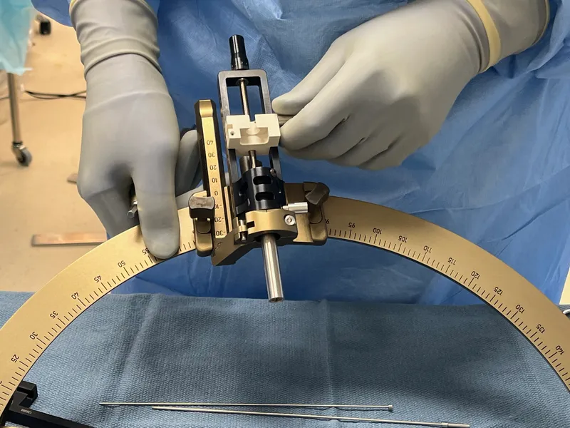 Stereotactic brain surgery showing precise anatomical targeting