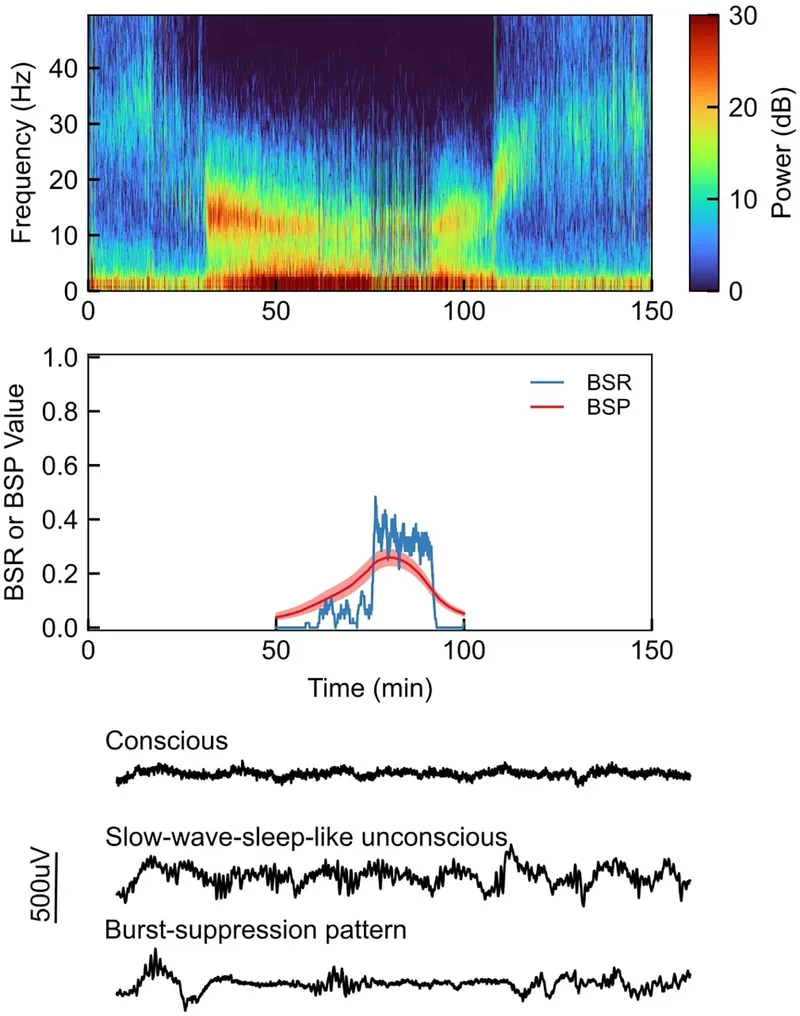 EEG waveforms showing burst suppression pattern during deep anesthesia