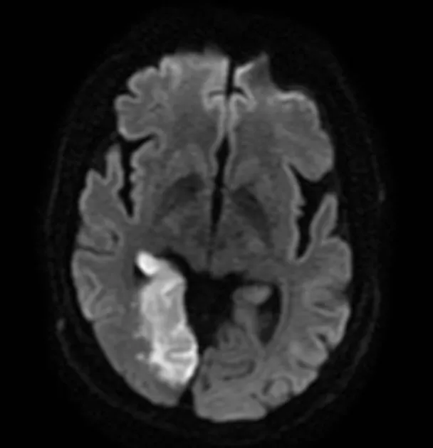 Figure 2: MRI brain diffusion-weighted imaging showing bright signal in left posterior cerebral artery territory acute infarct