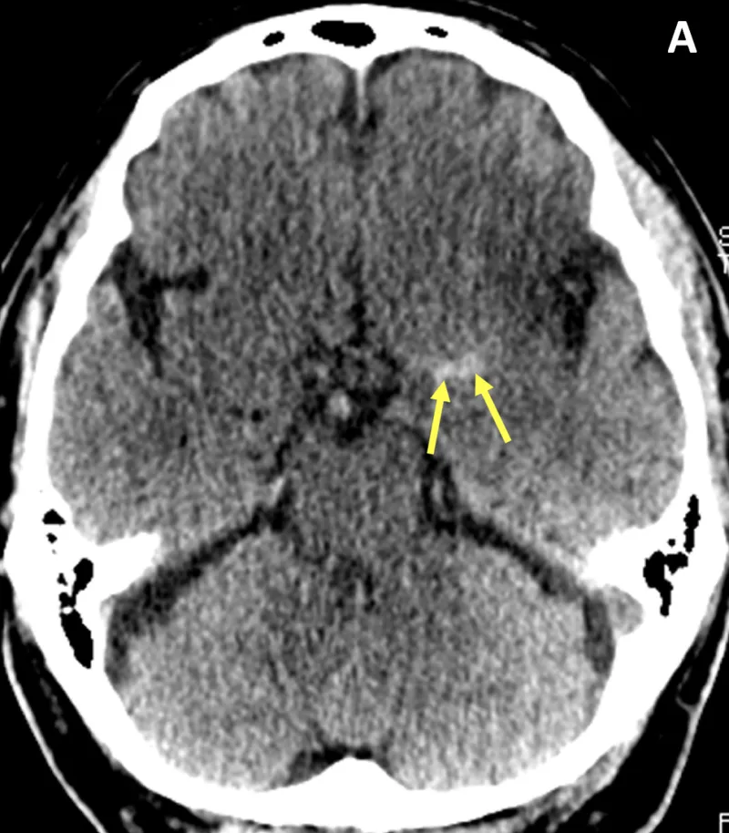 Figure 1: CT brain showing hyperdense left middle cerebral artery sign indicating acute thrombus