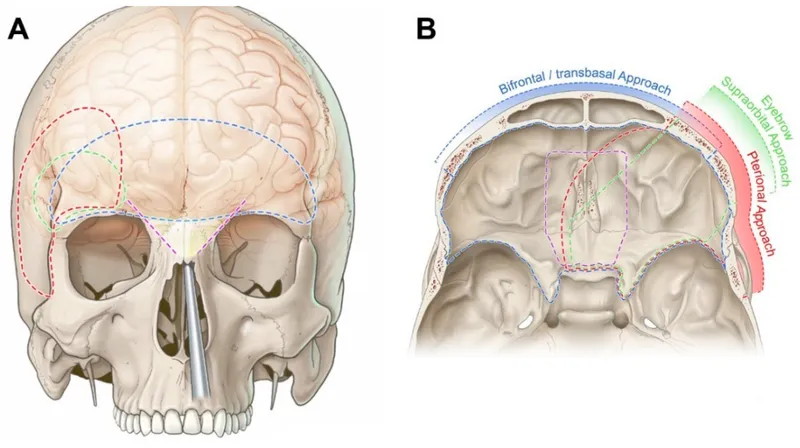Lateral view of skull showing pterional craniotomy surgical landmarks