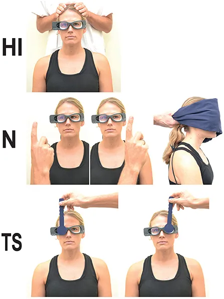 Clinical photograph showing nystagmus examination with Frenzel goggles