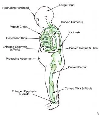 Clinical examination findings for various nutritional deficiencies