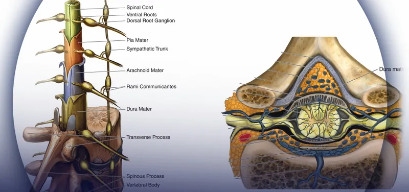 Detailed anatomical cross-section showing spinal and epidural needle placement
