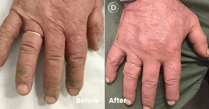 Before and after treatment photos showing resolution of occupational hand dermatitis