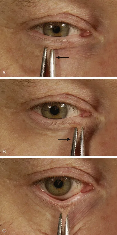 Clinical demonstration of eyelid laxity testing techniques