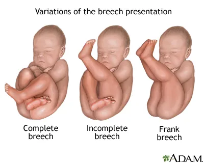 Breech presentation types and delivery considerations