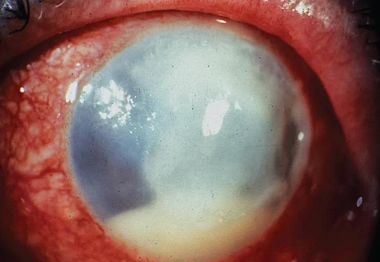 Slit lamp photograph showing bacterial keratitis with corneal infiltrate and hypopyon
