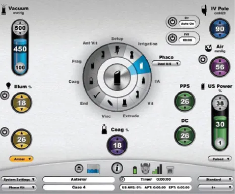 Surgical monitoring display showing intraocular pressure and irrigation parameters