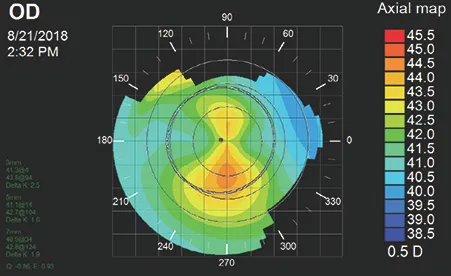 Corneal topography showing keratoconus irregular astigmatism pattern