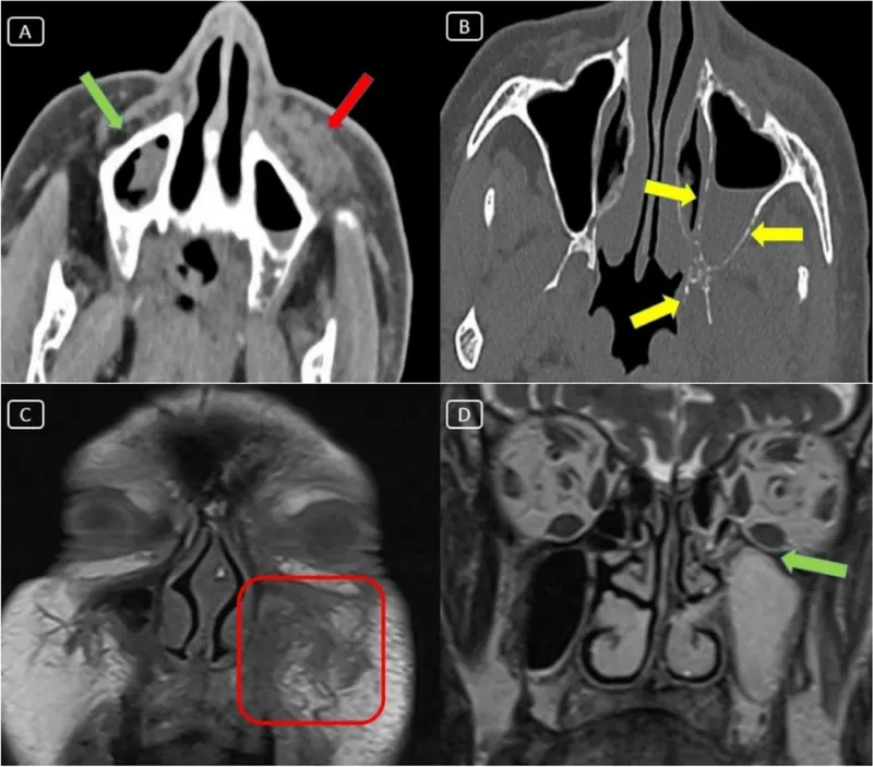 CT scan showing invasive fungal sinusitis with orbital extension and bone destruction