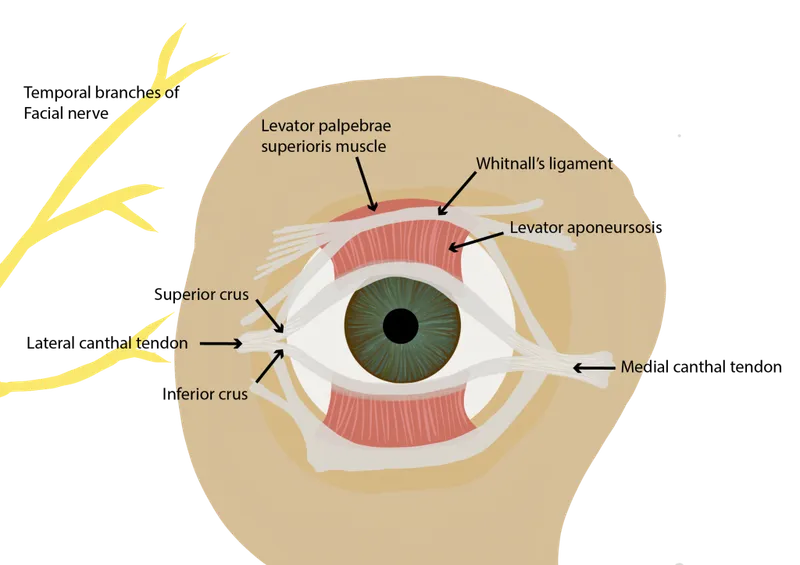 Lateral canthotomy procedure showing surgical technique for orbital decompression