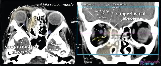 CT scan showing orbital cellulitis with subperiosteal abscess and proptosis