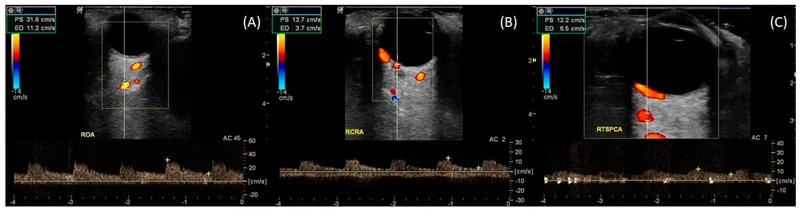 Color Doppler ultrasound showing orbital blood flow velocities in normal and diseased states