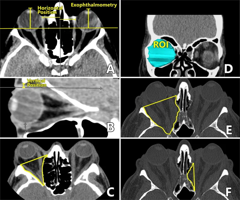 Clinical photograph showing orbital examination technique with proptosis measurement