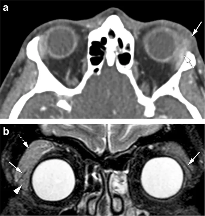 Orbital sarcoidosis showing bilateral lacrimal gland enlargement on coronal MRI