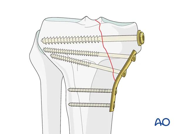 Comparison of absolute versus relative stability fixation methods