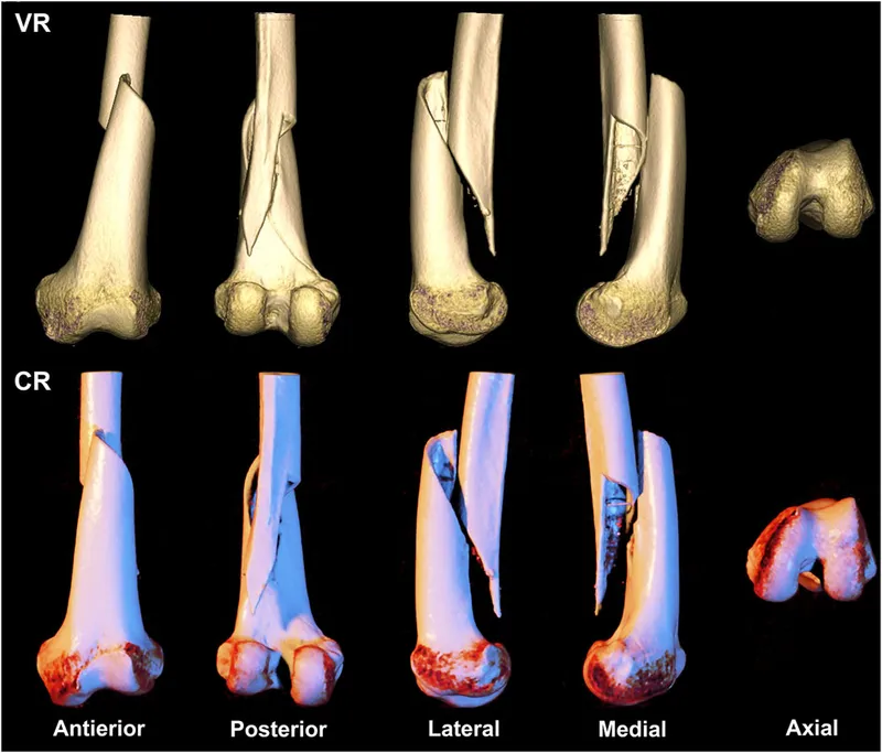 AO fracture classification system with pattern recognition examples