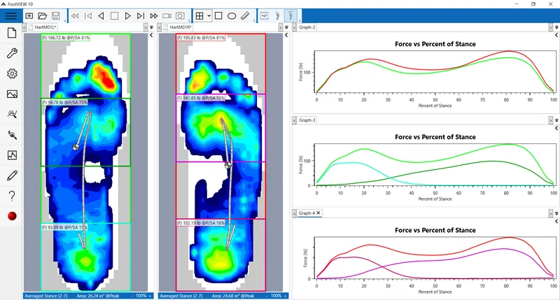 Pressure mapping analysis showing foot loading patterns during gait