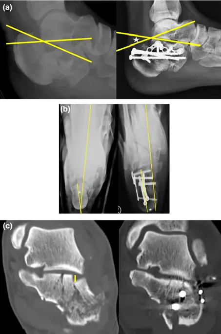 Radiographic image showing complex fracture pattern with measurement annotations