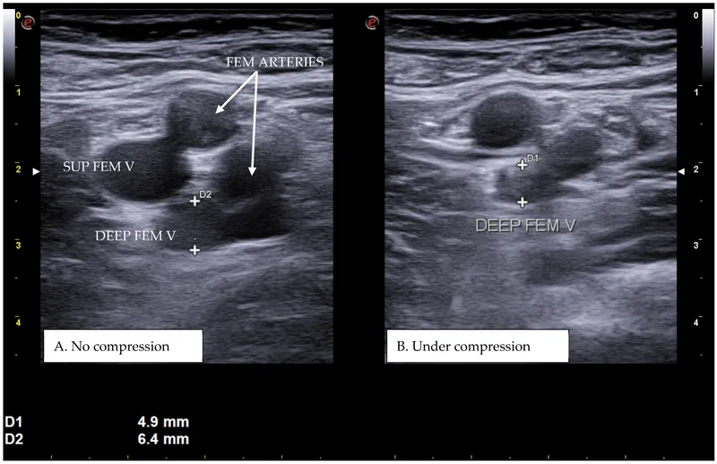 Doppler ultrasound image showing deep vein thrombosis in lower extremity