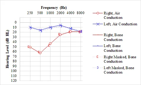 Audiogram patterns showing different types of hearing loss with characteristic configurations