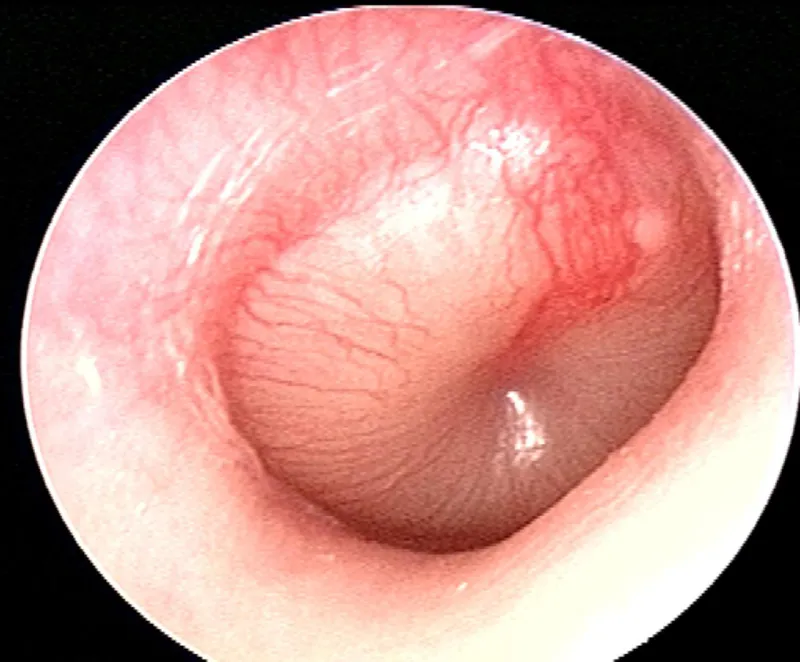 Emergency department otoscopic examination showing acute otitis media with bulging tympanic membrane
