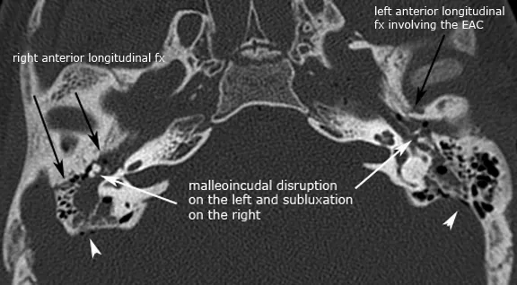 Temporal bone CT scan showing longitudinal fracture with ossicular chain disruption