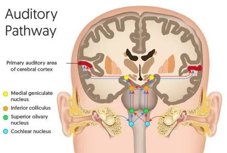 Brain MRI showing auditory processing pathways from cochlea to cortex