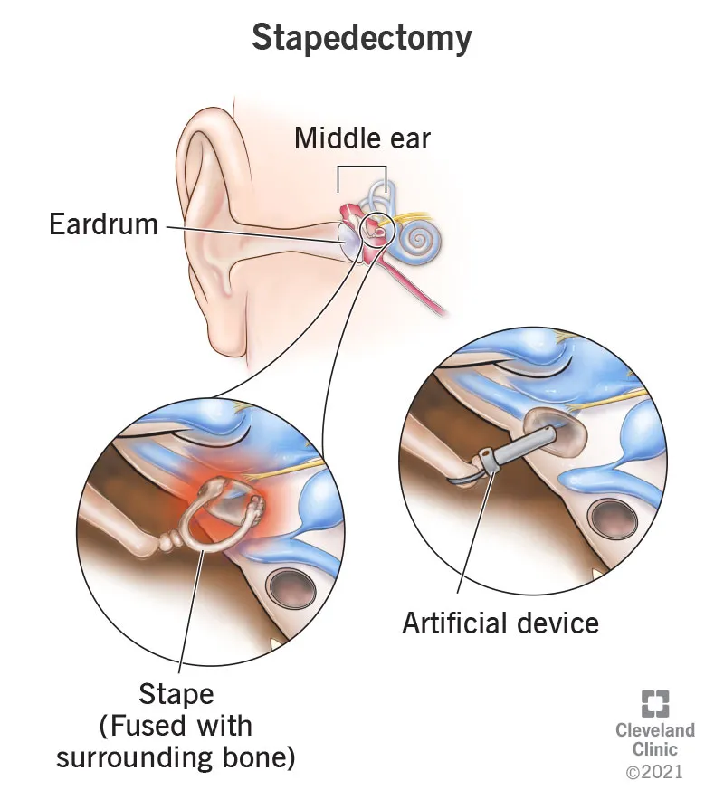 Surgical view of stapedectomy procedure showing stapes removal and prosthesis placement