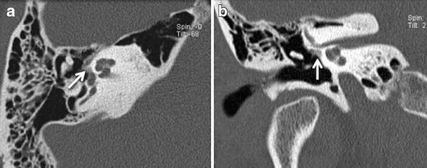 Comparative CT images showing otosclerosis vs ossicular chain disruption