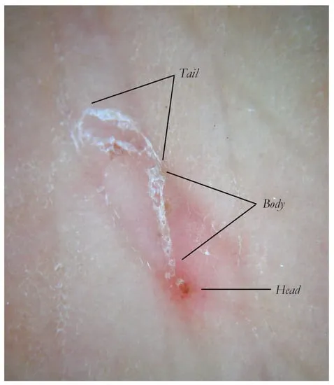 Dermoscopic comparison showing parasitic vs non-parasitic linear skin lesions