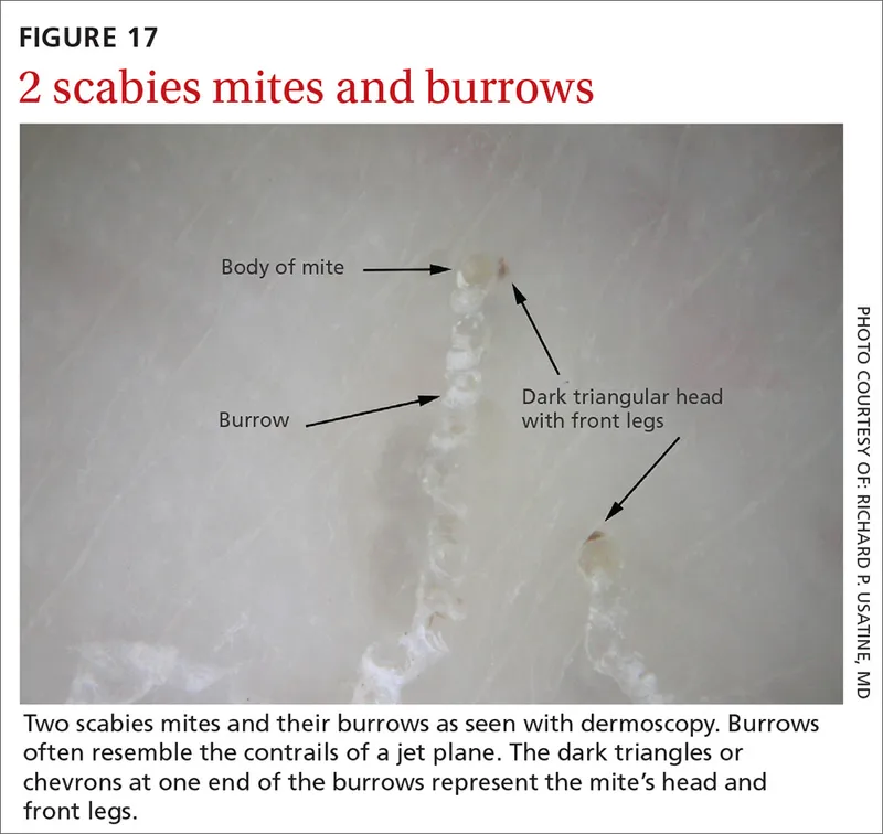 Dermoscopic images showing detailed morphological features of parasitic skin lesions