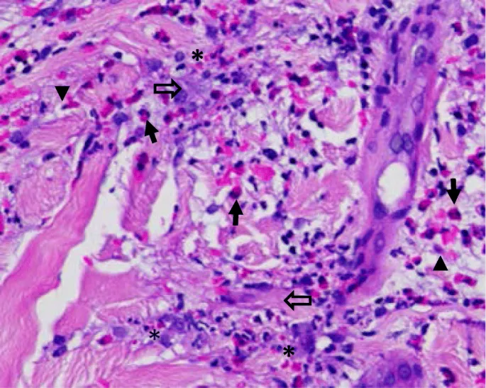 Microscopic view of eosinophil infiltration in parasitic skin infection