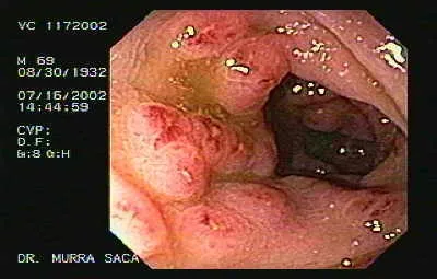 Gastrointestinal manifestations of parasitic infections