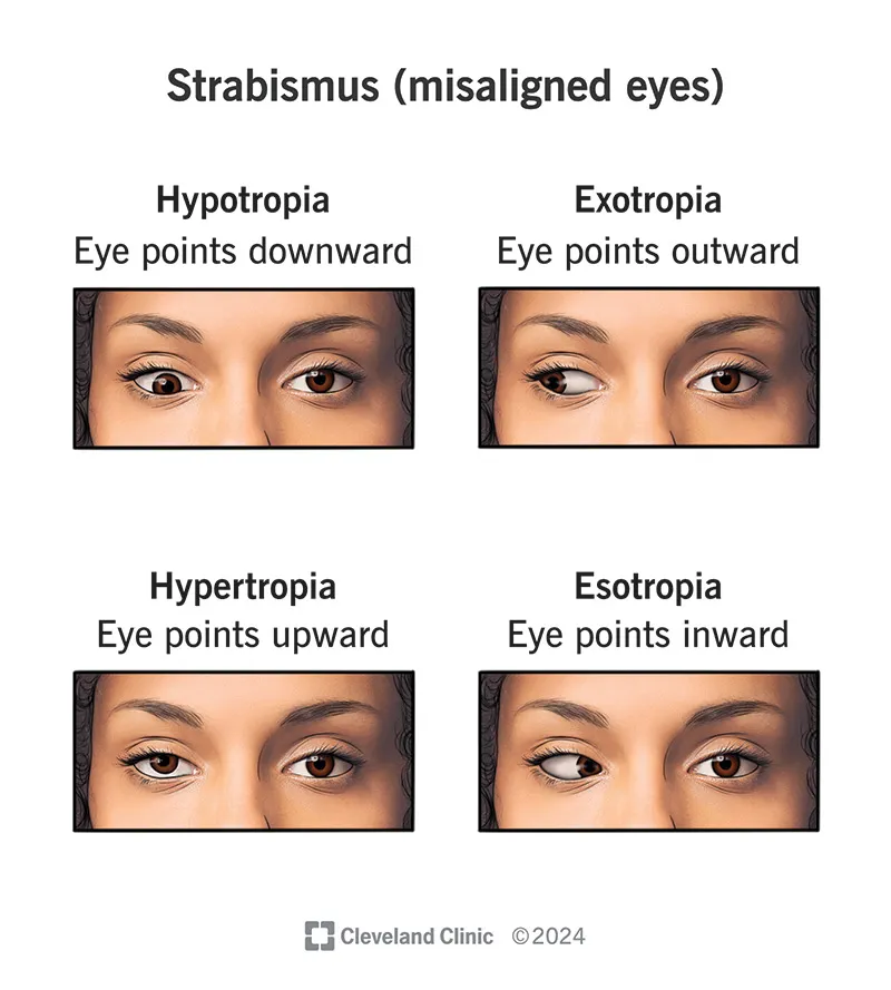Clinical photographs demonstrating different strabismus types and measurements