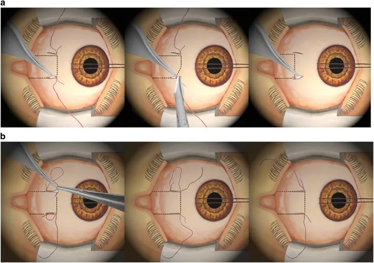 Surgical planning diagram showing extraocular muscle procedures