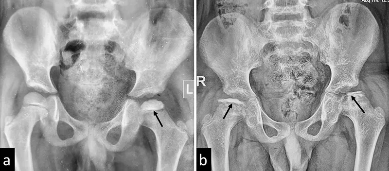 Radiographic comparison showing different pediatric hip pathologies