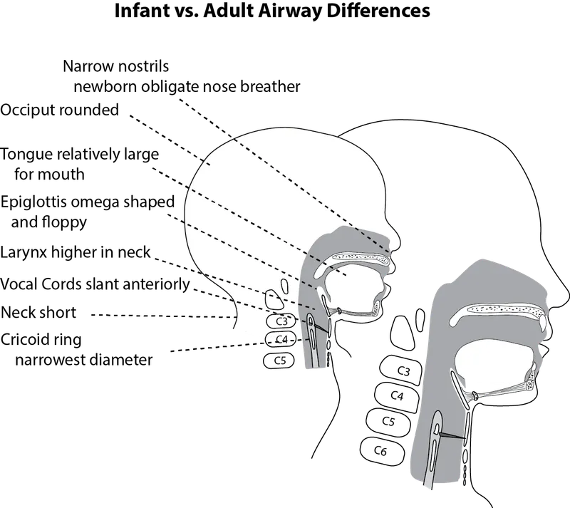 Cross-sectional anatomy of pediatric vs adult larynx showing cricoid narrowing