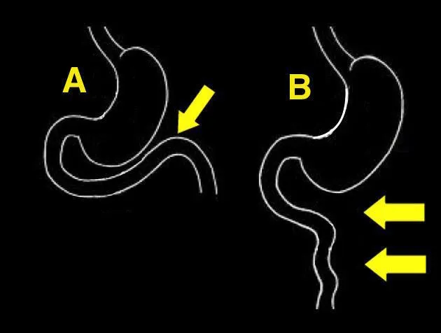 Upper GI series showing malrotation with abnormal ligament of Treitz position